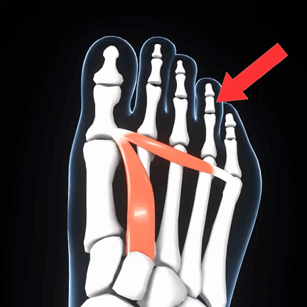 Treatmedy Bunion Fix